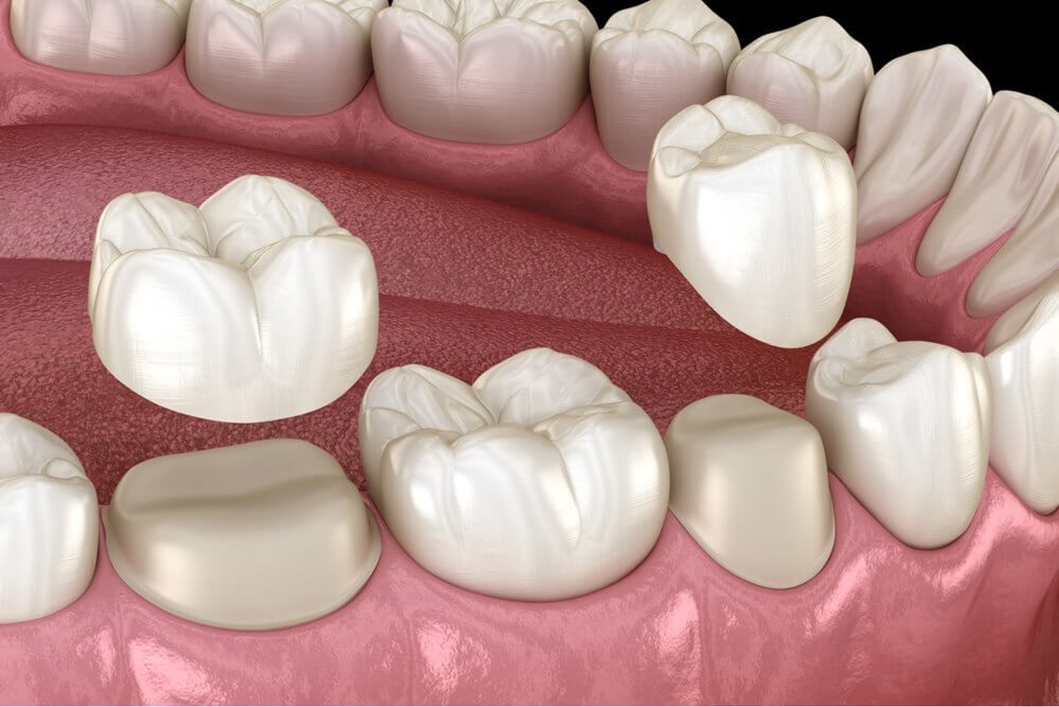 Dental crown in Lahore